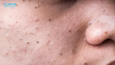 lột mụn có tác dụng gì