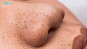 lột mụn có tác dụng gì