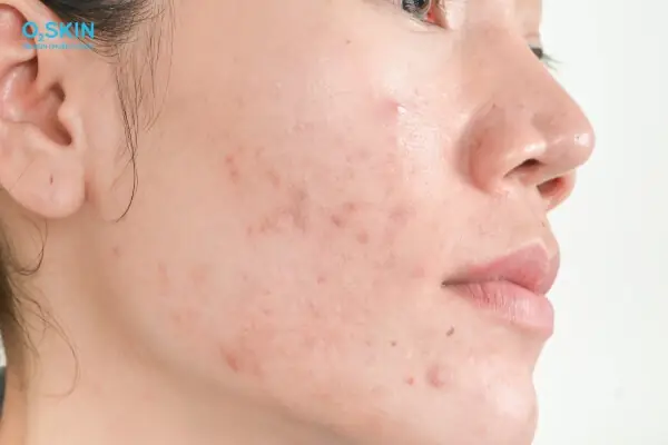 1. Đâu là nguyên nhân gây ra thâm mụn?