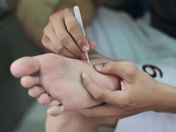 Lấy dằm ra bằng nhíp
