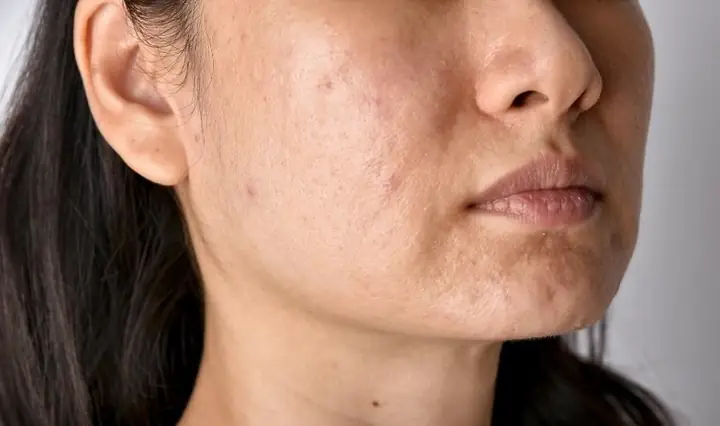 1Mụn ẩn là gì?