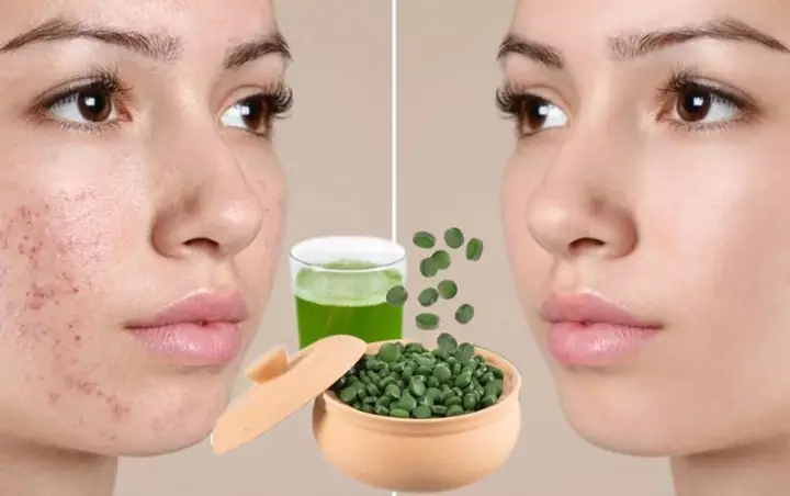 1. Cách đắp mặt nạ bằng viên tảo xoắn để trị mụn 1. Cách đắp mặt nạ bằng viên tảo xoắn để trị mụn