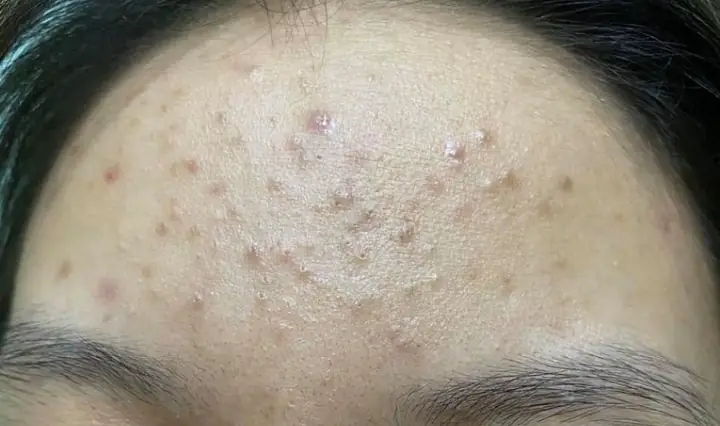 4Việc đẩy nhân mụn có tốt không?