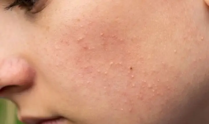 3.2. Giai đoạn làn da đẩy mụn