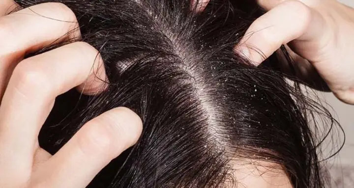 1.1 Da đầu tăng tiết dầu nhiều hơn