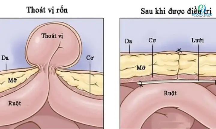 Trẻ sơ sinh bị lồi rốn có phải bị thoát vị rốn? Trẻ sơ sinh bị lồi rốn có phải bị thoát vị rốn?
