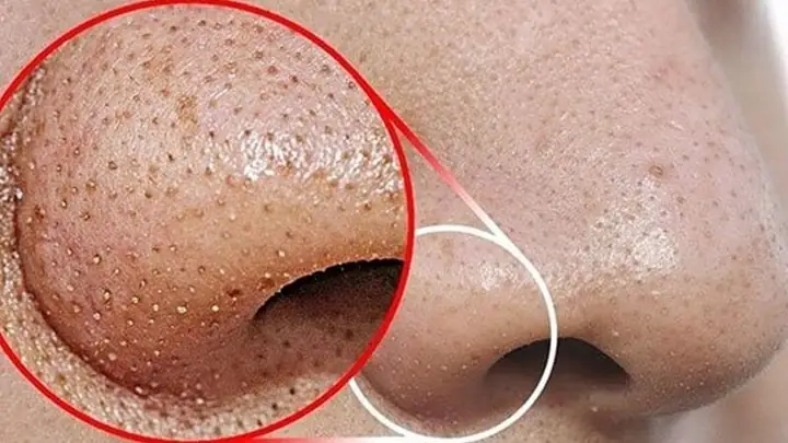 Mụn là nỗi ám ảnh và phiền toái của rất nhiều người vì tình trạng này không chỉ gây mất thẩm mỹ mà còn ảnh hưởng khá nhiều đến sự tự tin trong giao tiếp thường ngày. Cùng tìm hiểu cách làm sạch da mặt bị mụn hiệu quả giúp da nhanh phục hồi qua bài viết này nhé!