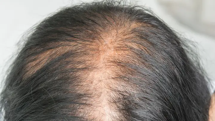 Rụng tóc sau sinh bao lâu thì hết Rụng tóc sau sinh bao lâu thì hết