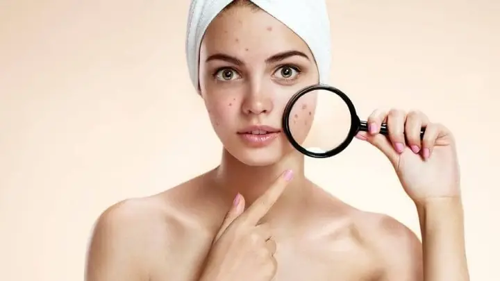 Cải thiện tình trạng mụn Cải thiện tình trạng mụn