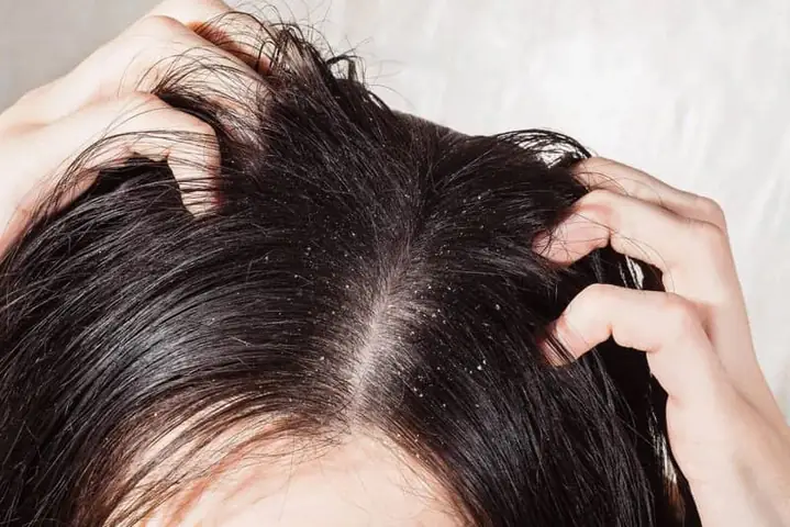 Điều trị gàu và nấm da đầu