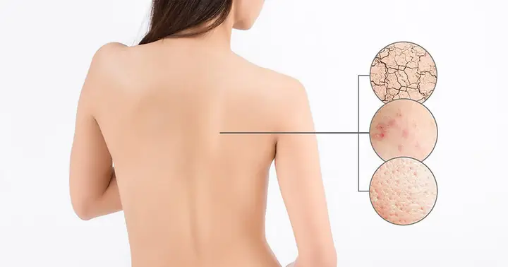 Vì sao cần tẩy tế bào chết cho body?