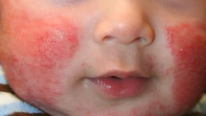 1. Chàm sữa do đâu?