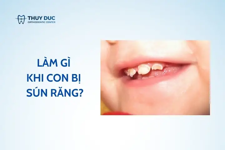 Răng sún ở trẻ em, nguyên nhân, ảnh hưởng và phương pháp điều trị 1
