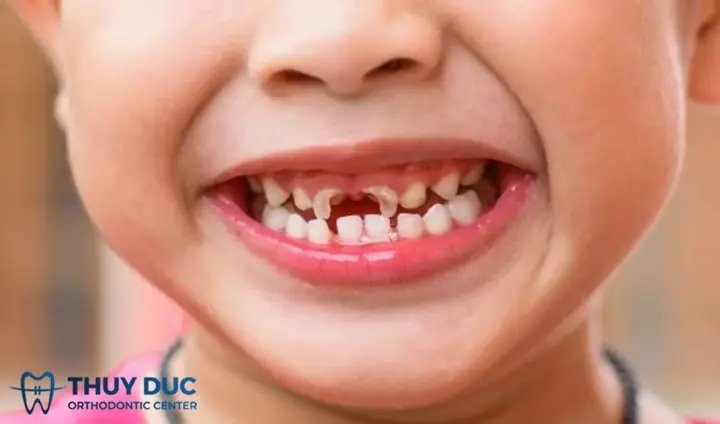 Cách điều trị răng sún