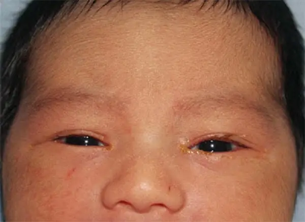trẻ sơ sinh bị tắc tuyến lệ