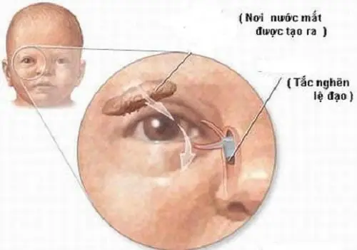 trẻ sơ sinh bị tắc tuyến lệ