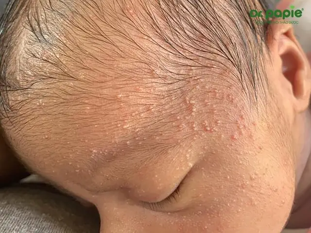 Trẻ sơ sinh bị nổi mụn sữa trên đầu
