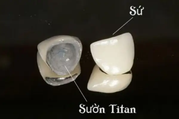 1. Răng sứ kim loại Titan là gì?
