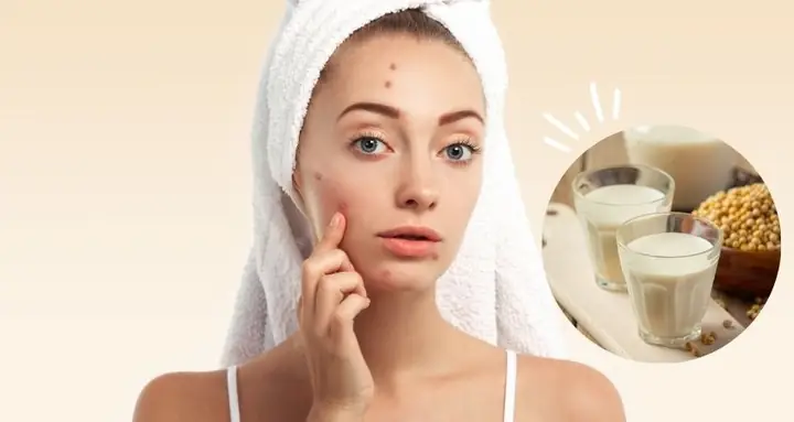 1Da đang bị mụn có nên uống sữa đậu nành không?