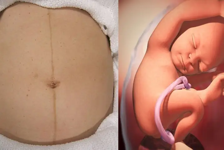 1Nguyên nhân xuất hiện vạch nâu ở bụng?