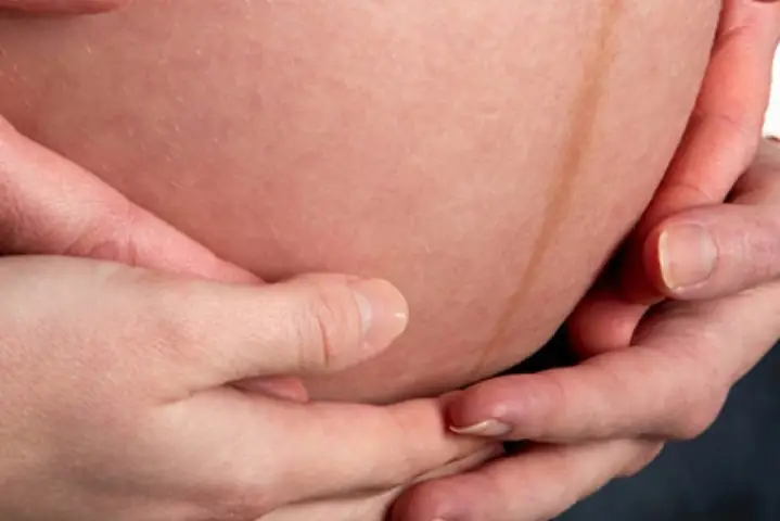 3Mẹ bầu có thể ngăn ngừa vạch nâu ở bụng được không?